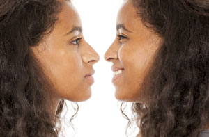 Rhinoplasty Middlesbrough