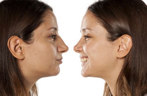 Rhinoplasty UK