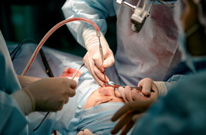 Rhinoplasty Surgeon Exeter Devon or Near Me