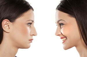 Rhinoplasty Bath Somerset (BA1)